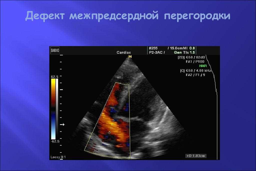 Дефект межпредсердной. Дефект межпредсердной перегородки УЗИ. Дефект межпредсердной перегородки эхокардиография. УЗИ сердца дефект межпредсердной перегородки. Дефект межжелудочковой перегородки (ДМЖП) диф диагноз.