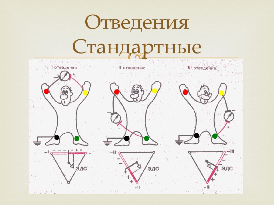 Усиленные отведения экг схема