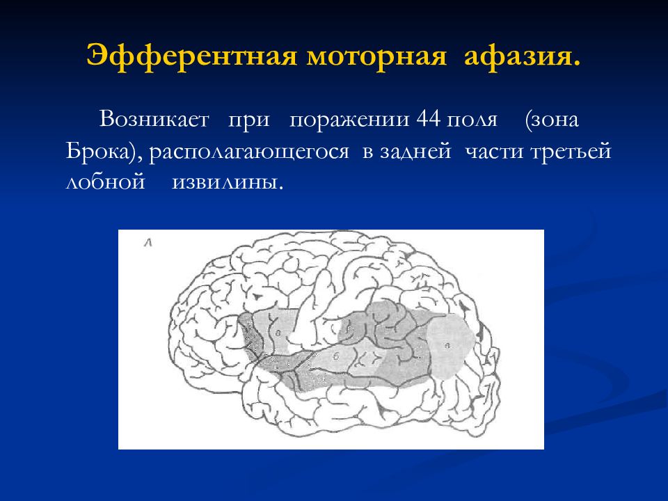 Афазии локализации поражения. Сенсорная афазия Вернике возникает при поражении. Сенсорная афазия зона поражения. Зона Брока афазия. Афазия Брока очаг.