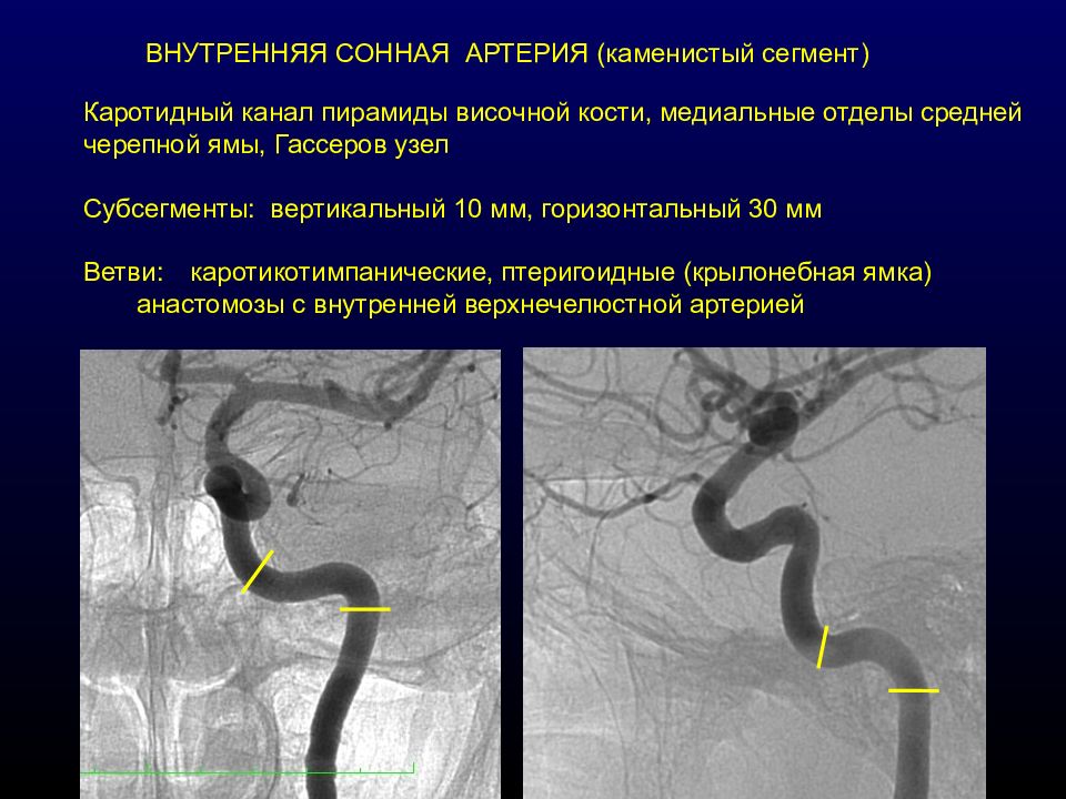Изгиб вса. Супраклиноидный отдел внутренней сонной артерии на кт. Анатомия сифона внутренней сонной артерии. Отделы внутренней сонной артерии анатомия. Сегменты ВСА головного мозга.