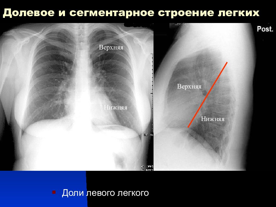 Пневмония в правом легком в нижней доле. Нижнедолевая пневмония слева рентген. Сегментарная пневмония рентген. Междолевые щели легких на рентгенограмме. Междолевые щели на рентгене легких.