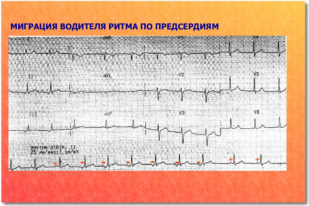 Блок схема аритмии