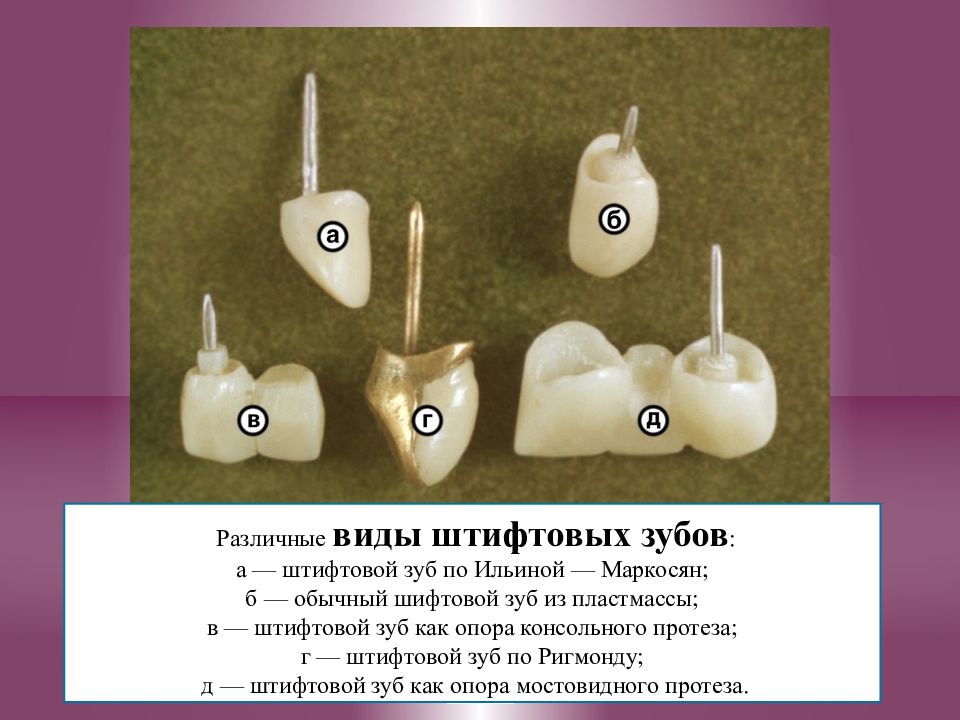 Штифтовые зубы. Штифтовой зуб по Ильиной-Маркосян. Коронка Ильиной Маркосян. Вкладка Ильиной Маркосян. Штифтовой зуб Ричмонда Ильиной Маркосян.