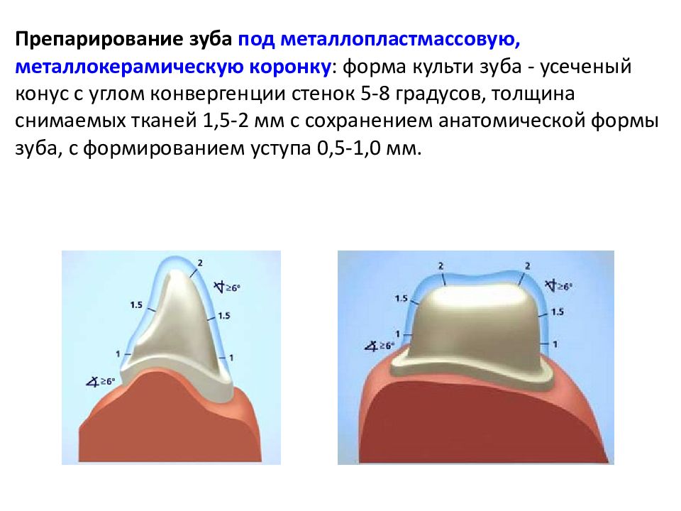 Препарирование под металлокерамическую коронку с уступом в картинках