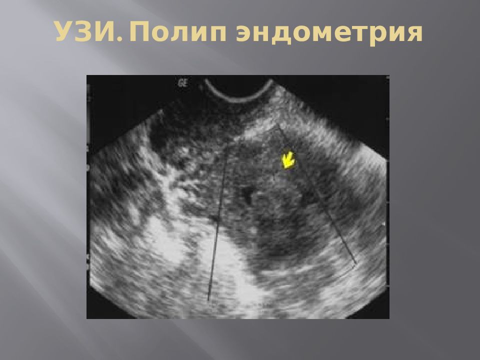 Эндометрий нечеткий. Полип и гиперплазия эндометрия на УЗИ. Эндометриальный полип на УЗИ.