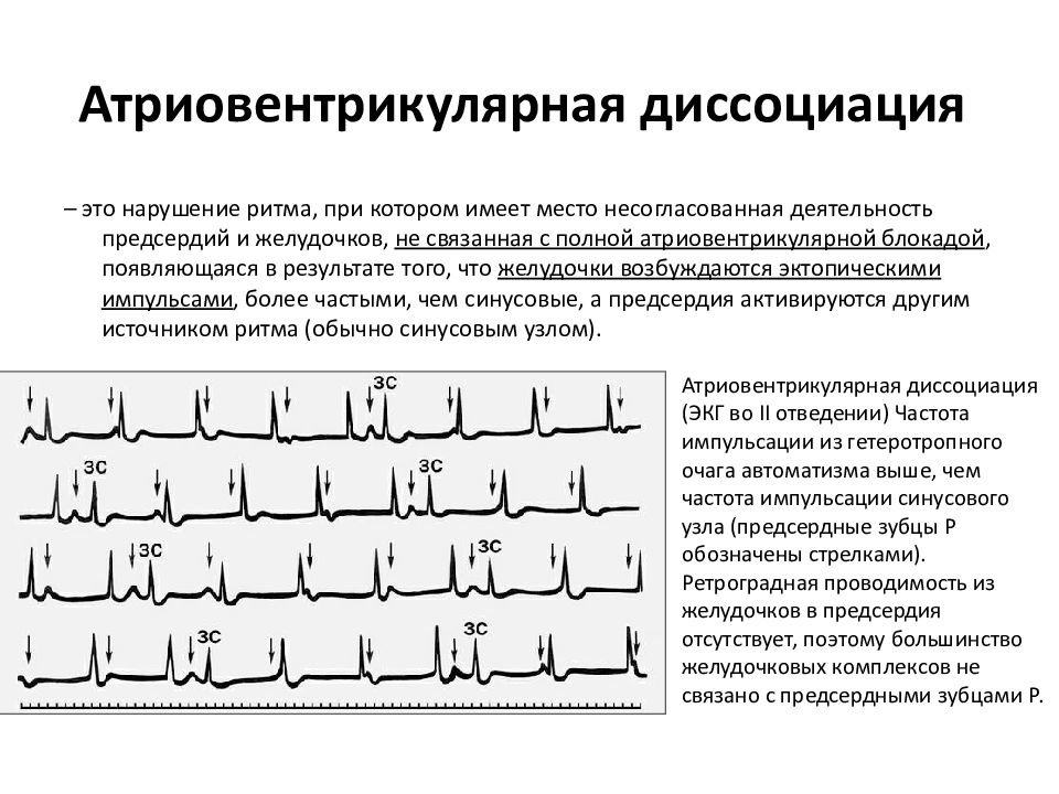 Предсердный ритм. ЭКГ при атриовентрикулярной диссоциации. Изоритмическая АВ диссоциация на ЭКГ. Неполная АВ диссоциация на ЭКГ. АВ диссоциация на ЭКГ критерии.