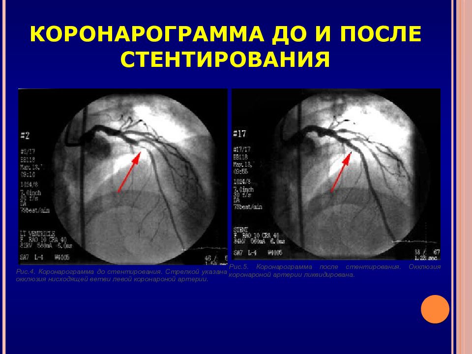 Что такое стент на сердце после инфаркта фото