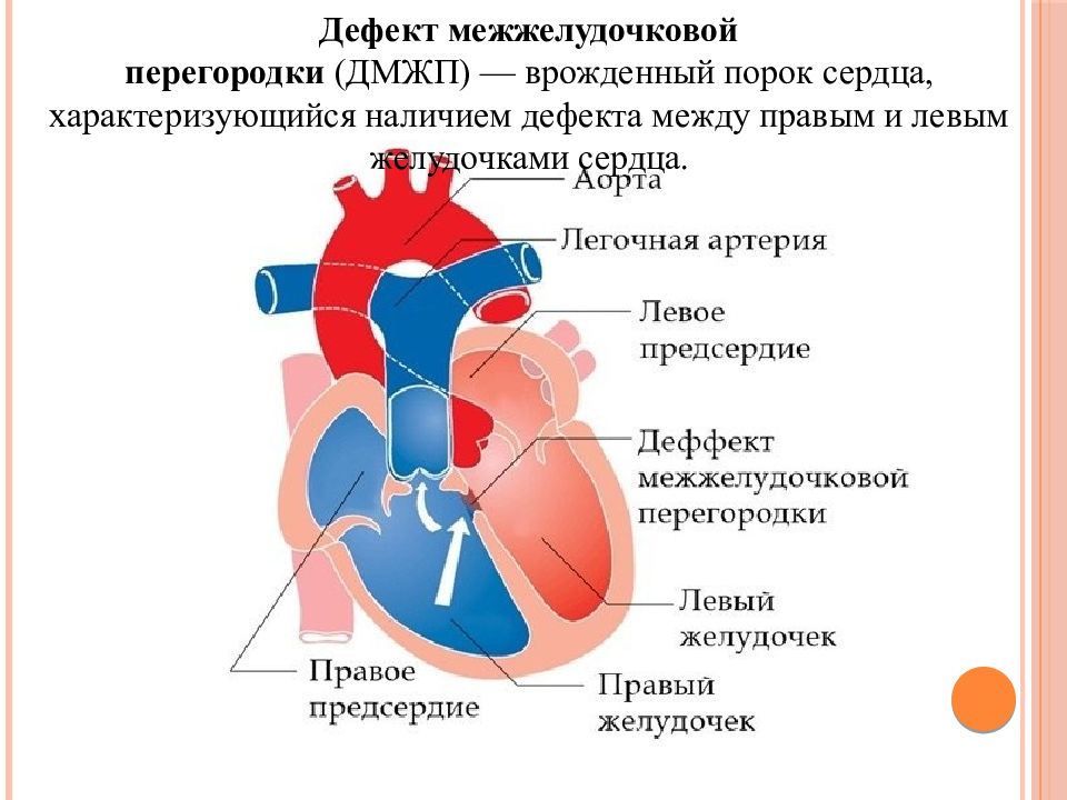 Между правым предсердием и левым желудочком. Дефект межжелудочковой перегородки схема. Аорта легочная перегородка. Дефект между межжелудочковой перегородки гемодинамика. Врожденные пороки сердца гемодинамика схемы.