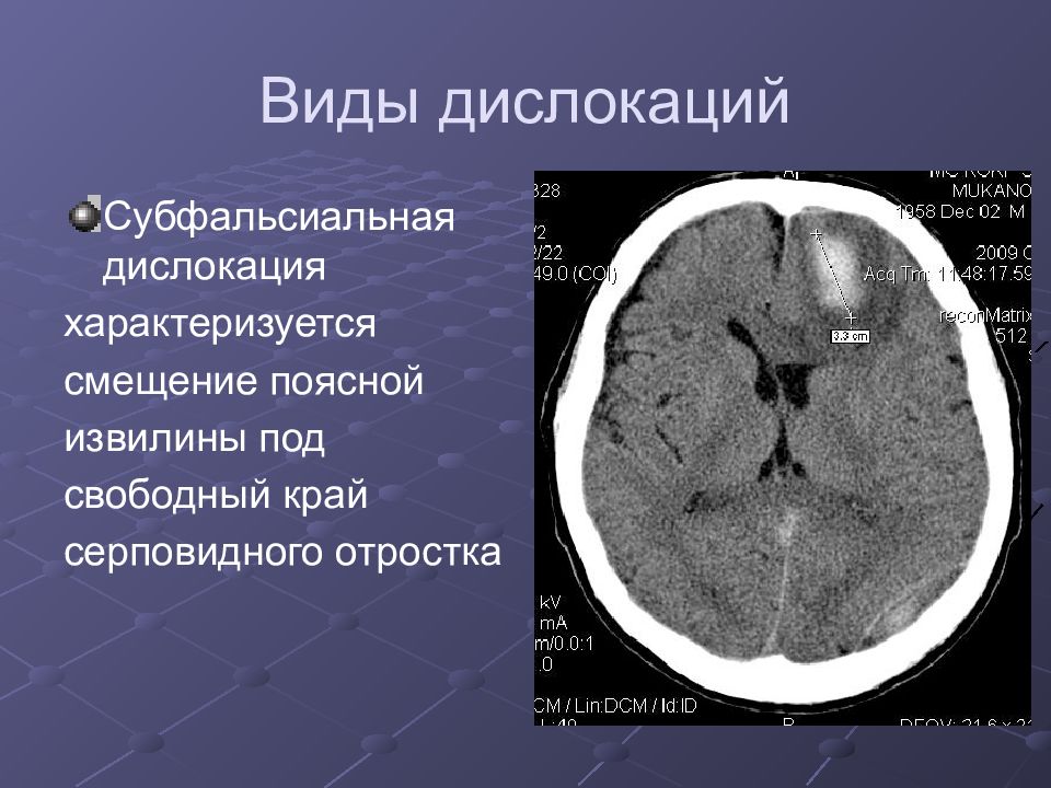 Кт головного мозга презентация