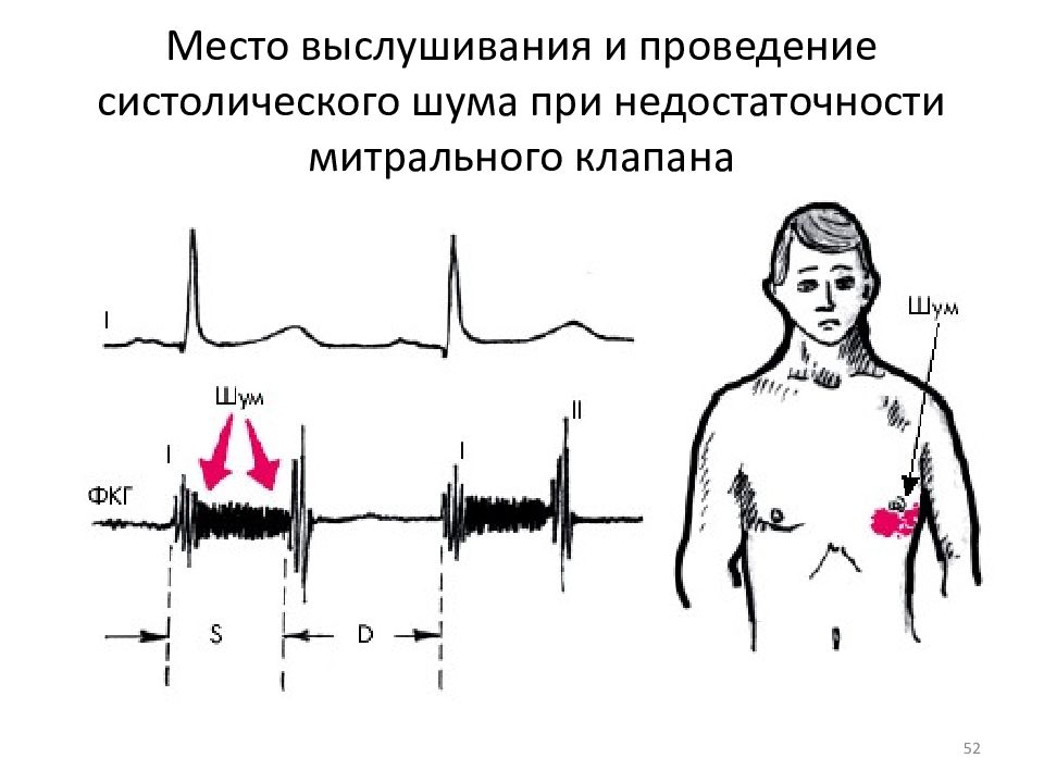 Шум при недостаточности митрального клапана. Митральная недостаточность ФКГ. Митральная недостаточность систолический шум. Шум при митральной недостаточности. Систолический шум на митральном клапане.