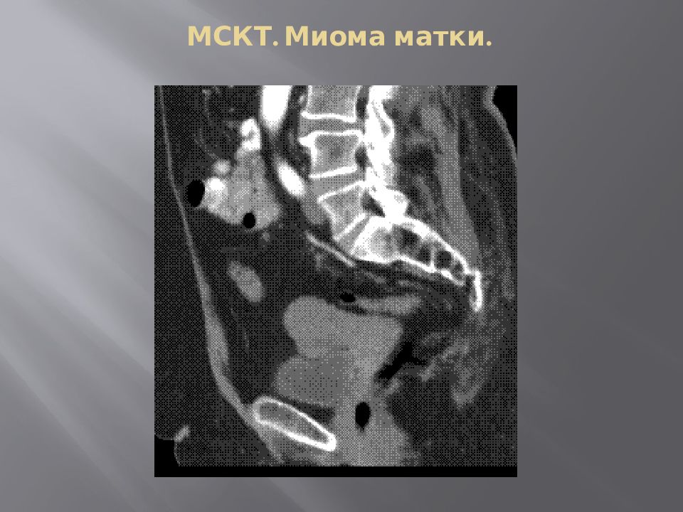 Как выглядит миома матки на мрт картинки