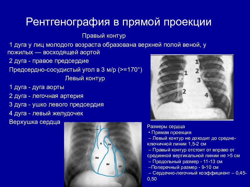 Рентгенография в 2 проекциях. Дуги сердца на рентгенограмме в прямой проекции. Прямая проекция сердца рентген норма. Дуги сердца на рентгене норма. Рентген сердца в прямой проекции норма.