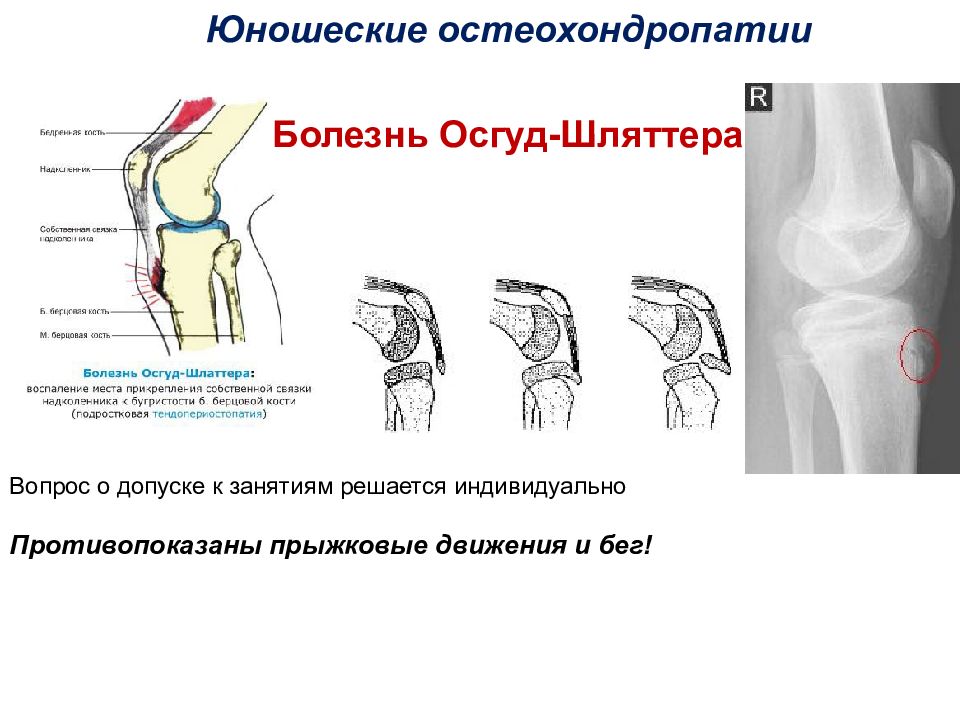 Бугристость большеберцовой кости. Синдром Осгуд Шляттера рентген. Синдром Осгуд Шляттера УЗИ. Болезнь Осгуда-Шлаттера рентген. Осгуд Шляттера у детей рентген.