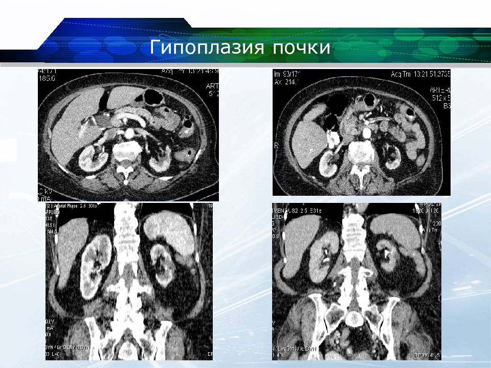 Гипоплазия почки. Сморщенная почка кт гипоплазия почки.