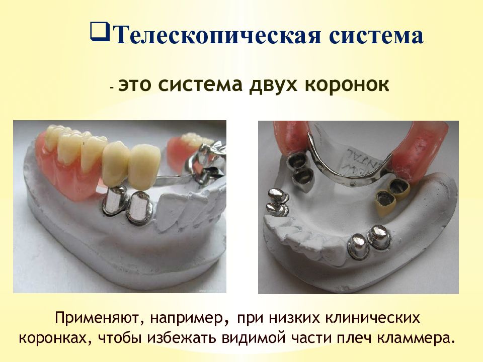 Пластиночные протезы презентация