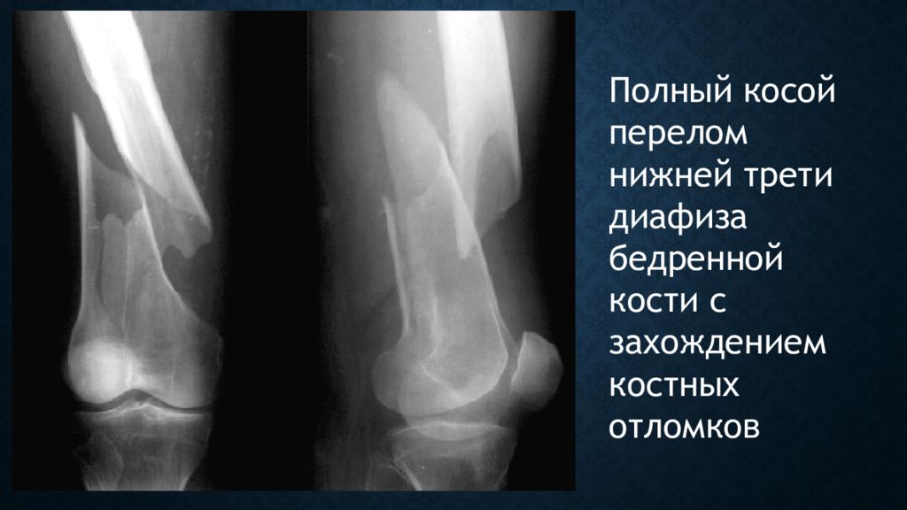 Презентация переломы диафиза бедренной кости