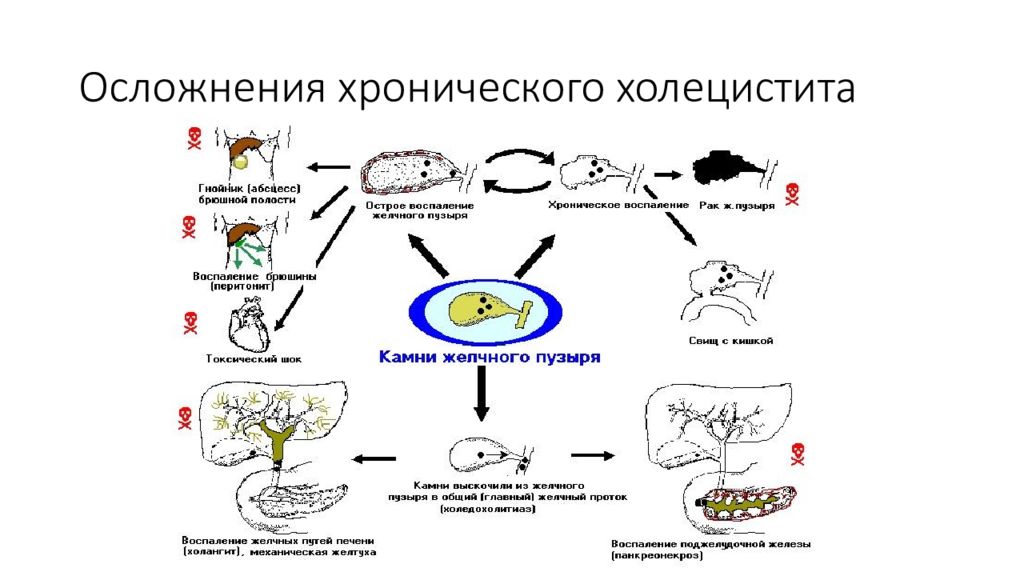 Калькулезный холецистит патогенез. Патогенез хронического холецистита кратко. Хронический холецистит этиология. Острый и хронический холецистит этиология. Осложнение острого холецистита клинические.