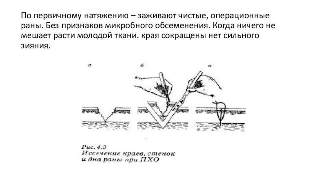 Заживление раны первичным и вторичным натяжением. Заживление первичным натяжением. Заживление РАН первичным натяжением. Заживление швов первичным натяжением. Первичное и вторичное заживление раны.
