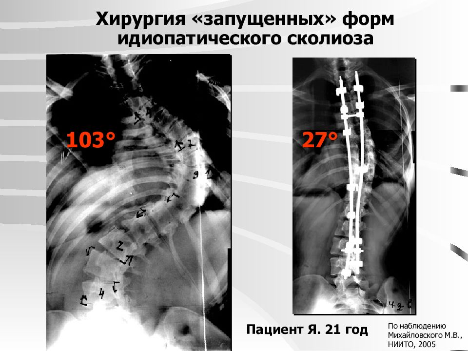 Идиопатический сколиоз 2 степени. Идиопатический сколиоз. Запущенные формы сколиоза. Идиопатический сколиоз Михайловский. Идиопатический сколиоз 2 степени у детей.