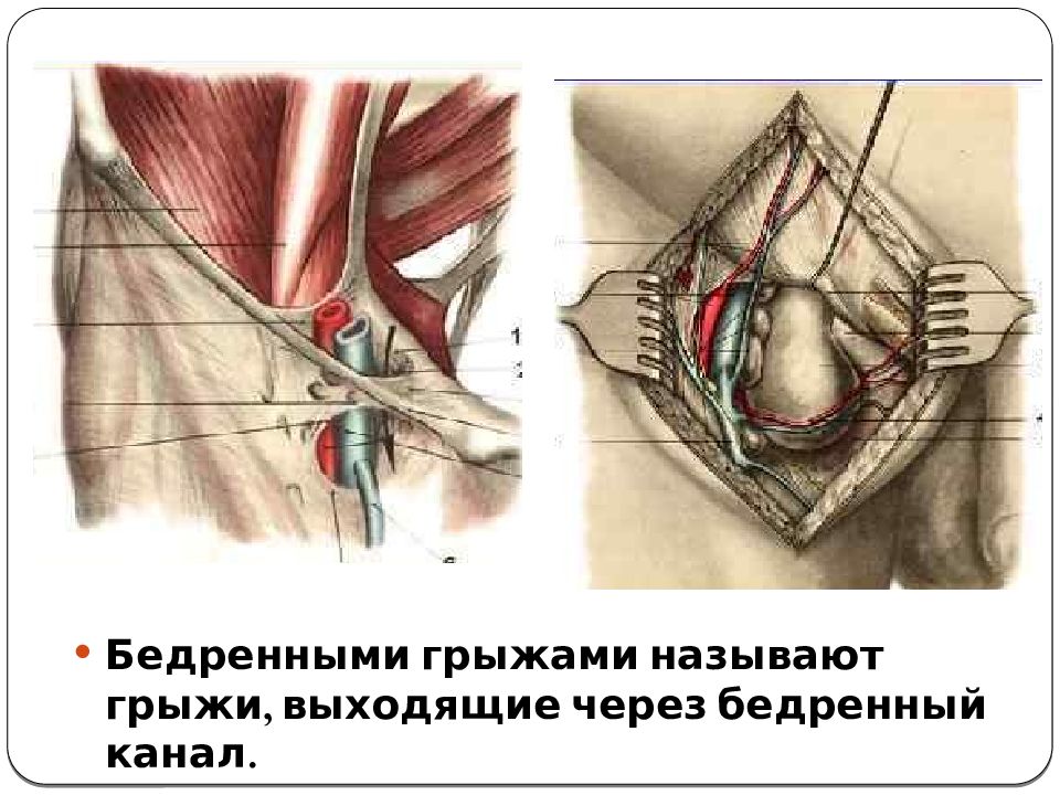 Бедренные грыжи топографическая анатомия презентация