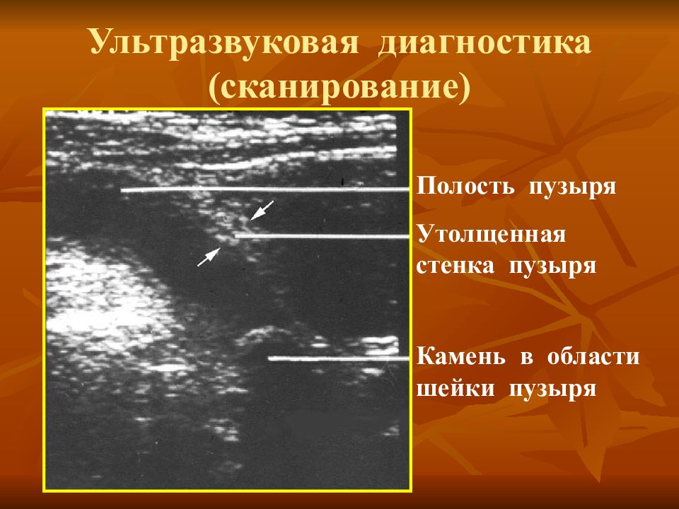 Острый калькулезный холецистит презентация