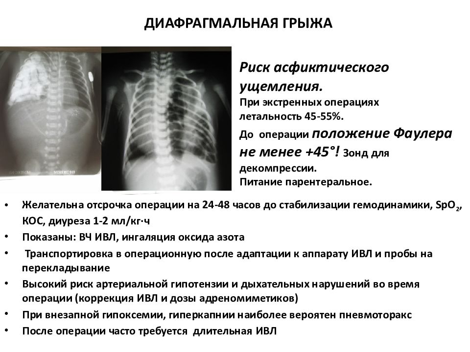 Диафрагмальная грыжа. Врожденная диафрагмальная грыжа симптомы. Грыжа диафрагмы рентген описание. Врожденная диафрагмальная грыжа проявляется симптомами:. Причины врожденной диафрагмальной грыжи.