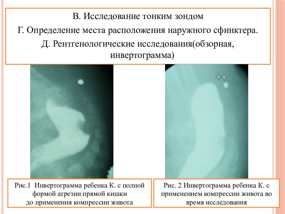 Клиническая картина ректальной формы болезни гиршпрунга характеризуется