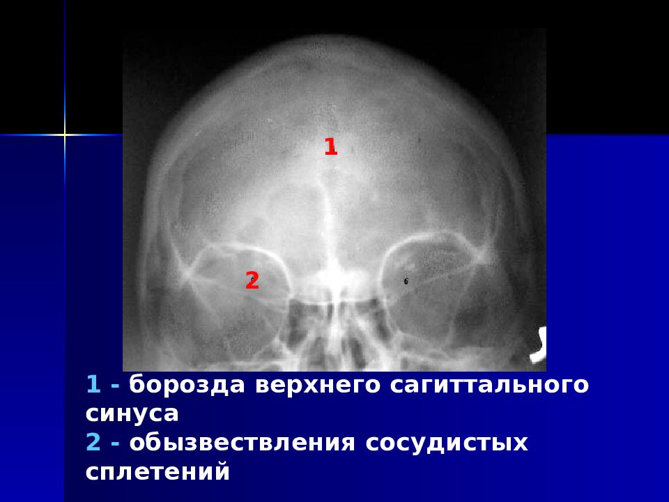 Шишковидная железа обызвествление. Обызвествление шишковидной железы рентген черепа. Борозды верхнесагитального синуса. Борозда верхнего сагиттального синуса. Обызвествление сагиттального синуса.