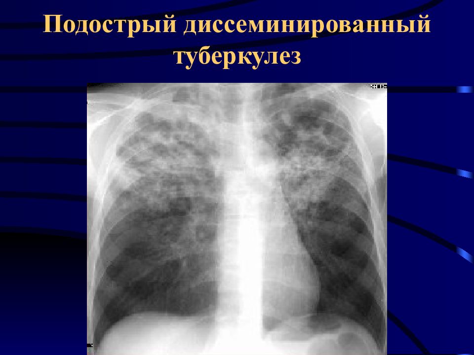 Милиарный туберкулез легких схема