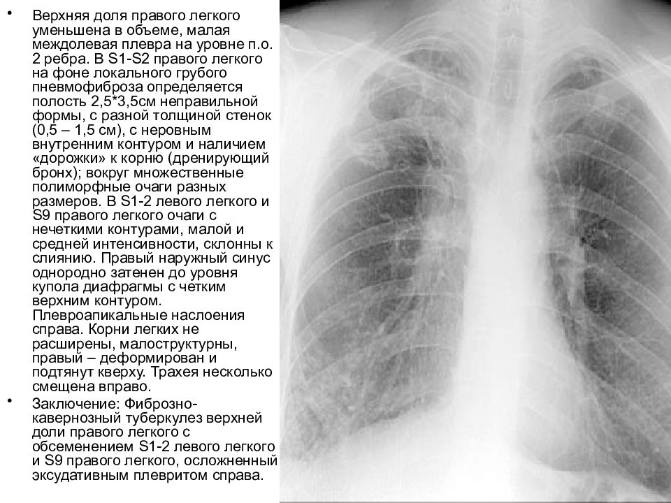 Корни малоструктурные легочный рисунок деформирован