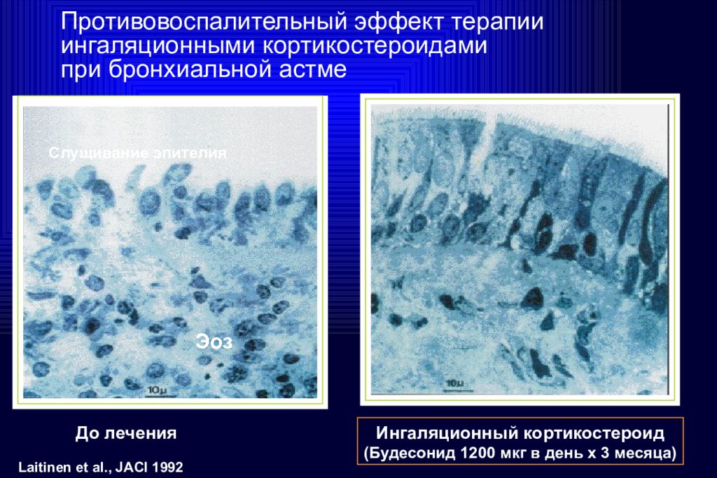 Мокрота при ба. Мокрота при бронхиальной астме. Бронхиальная астма мокрота. Мокрота при астме. Эпителий при бронхиальной астме