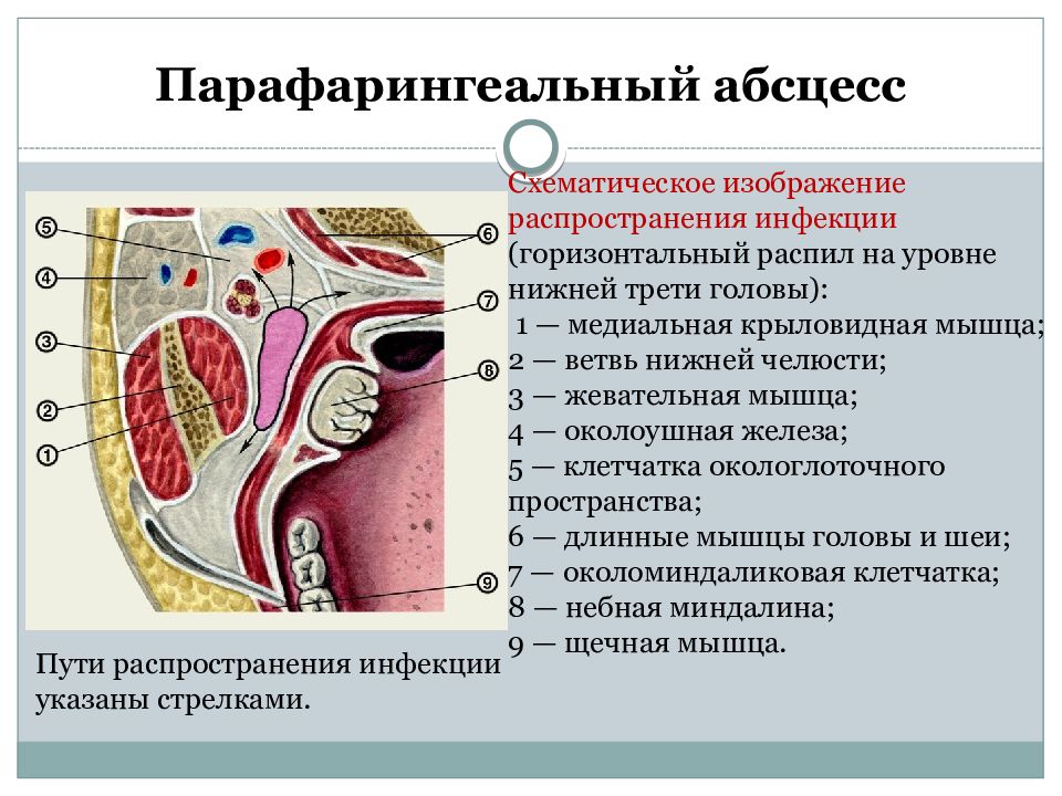 Заглоточный абсцесс. Абсцесс окологлоточного пространства. Парафарингеальный абсцесс. Парафарингеальный (окологлоточный) абсцесс. Парафарингеальное пространство.