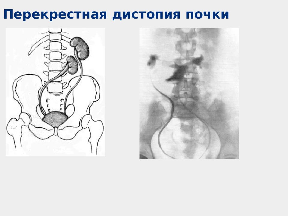 Нефроптоз дистопия. Поясничная дистопия почки рентген. Перекрестная дистопия почки. Подвздошная дистопия почки рентген.