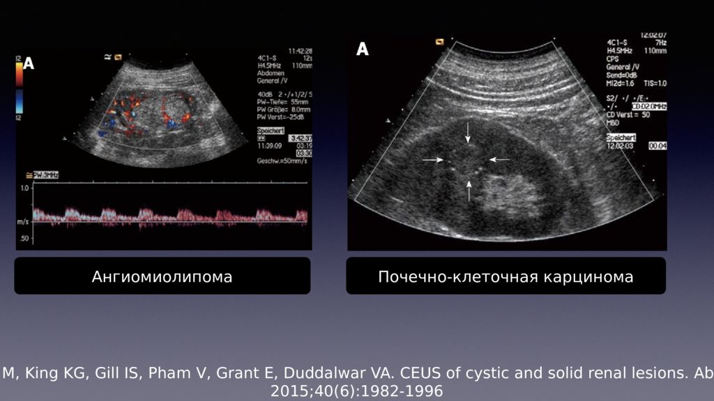 Код мкб ангиомиолипома почки. Ангиомиолипома на УЗИ. УЗИ презентация. Ангиомиолипома почки на УЗИ.