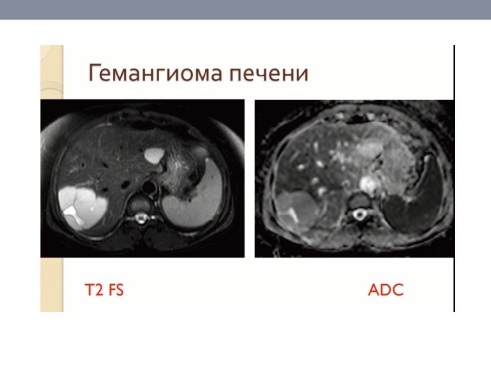 Образования печени мрт. Дифференциальная диагностика образований печени на кт. Жидкостные образования печени кт. Дифференциальный диагноз с очаговым образованием печени. Сосудистые образования печени кт.