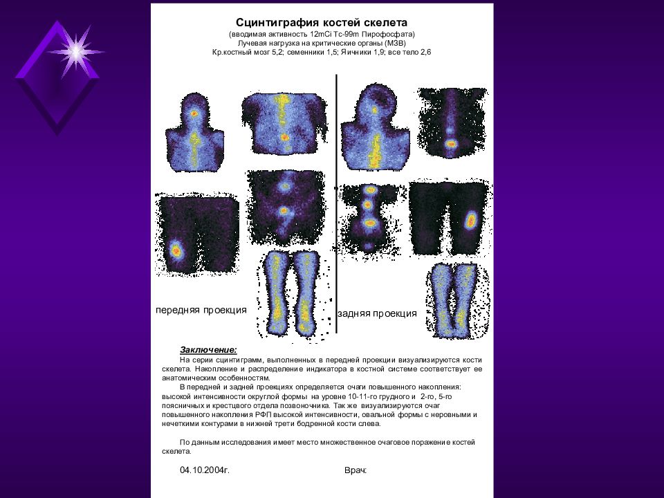 Сцинтиграфия это. Заключение сцинтиграфии костей скелета. Радионуклидное сканирование костей. Сцинтиграфия скелета норма. Сцинтиграфия костей расшифровка.