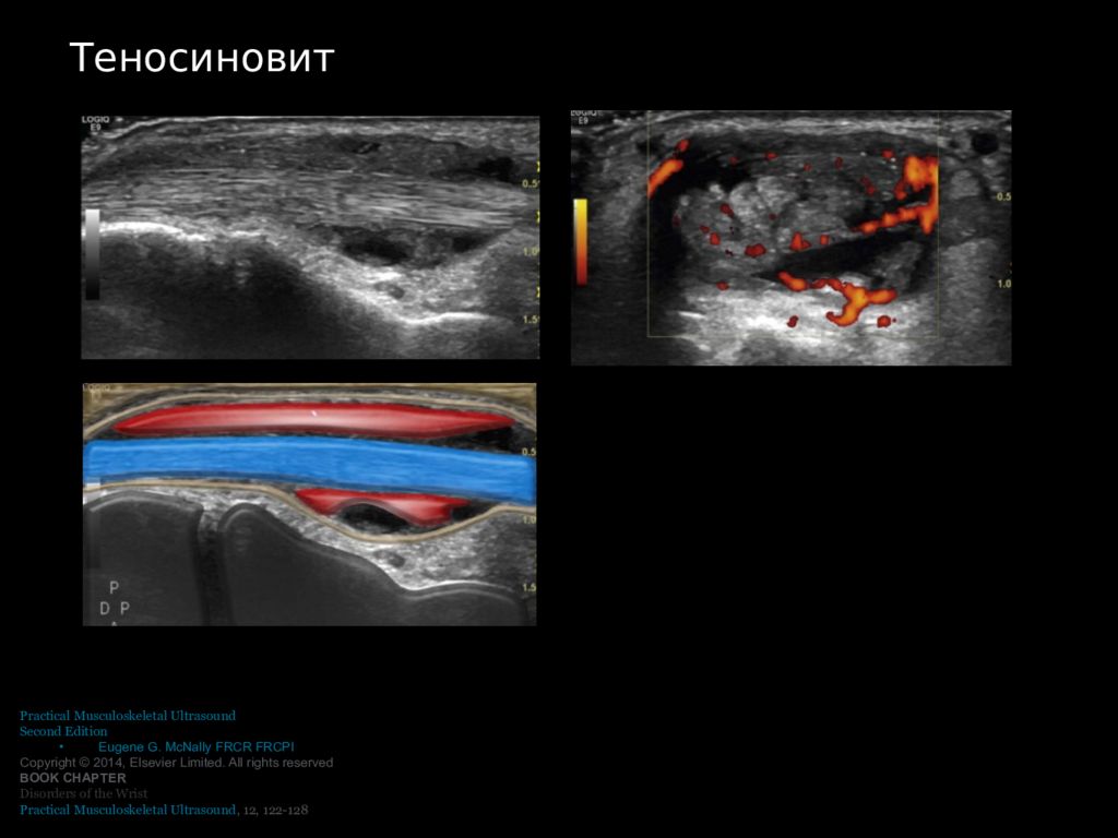 Узи кисти. Теносиновит де Кервена на УЗИ. Теносиновит голеностопного сустава на УЗИ протокол. Тендинит на УЗИ. Теносиновит коленного сустава на УЗИ.