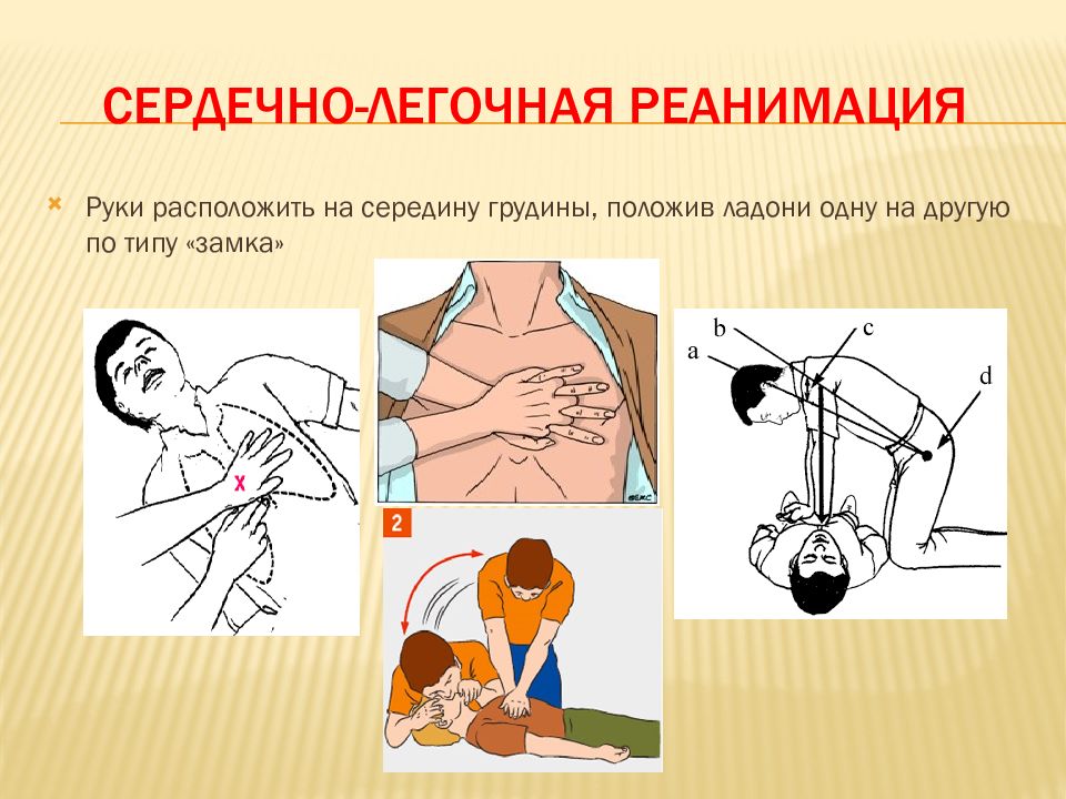 Частота надавливания при проведении компрессии грудной клетки. Серд легочная реанимация. Сердечно-легочная реанимация алгоритм расположение рук. Место компрессии грудной клетки при СЛР. Сердечно легочная реанимация ладонь.