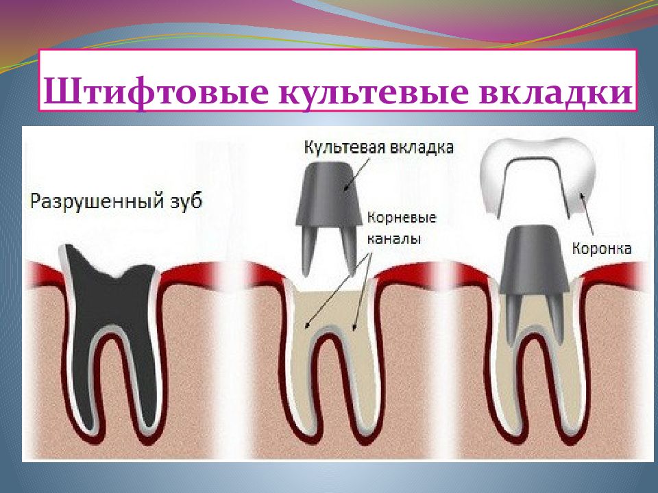 Какую коронку ставить. Штифтовая культевая вкладка. Культевая вкладка штифт зуб. Культевая вкладка разборная и неразборная. Культевая вкладка литая (КХС).