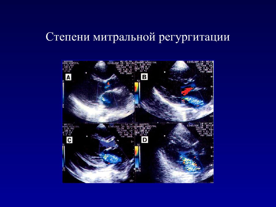 Митральная недостаточность 1 степени