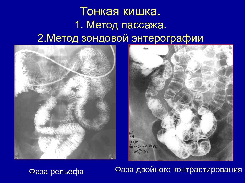 Энтерография. Двойное контрастирование тонкой кишки. Рентген контрастирование тонкого кишечника. Кт энтерография тонкого кишечника. Энтерография тонкого кишечника методика на кт.