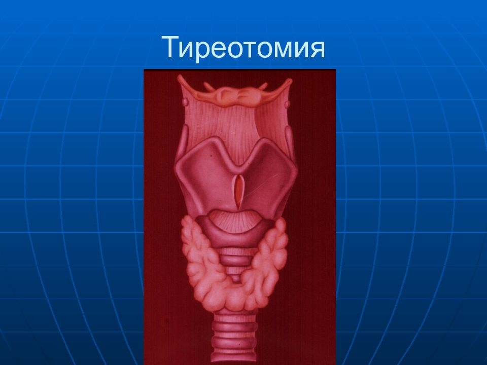 Трахеостомия. Верхняя и нижняя трахеостомия. Нижняя трахеостомия топографическая анатомия. Трахеостомия Оперативная хирургия. Трахеостомия верхняя средняя нижняя.