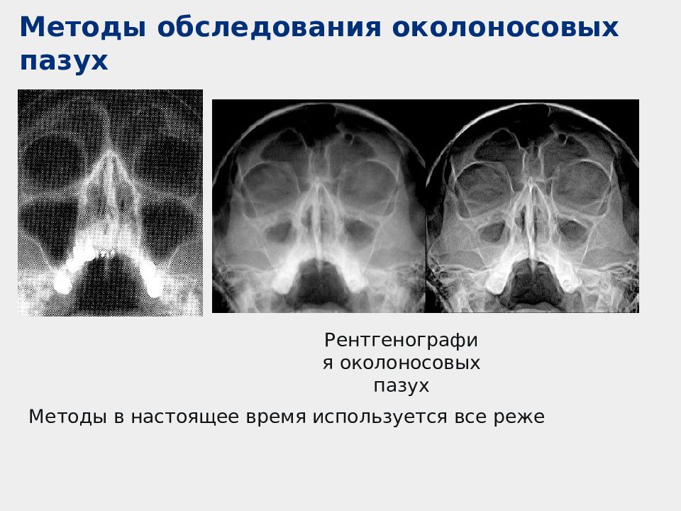 Верхнечелюстной синусит презентация