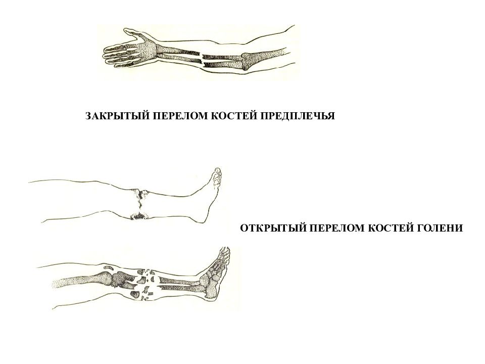 Перелом предплечья обе кости