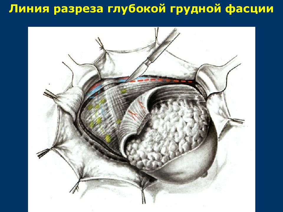 Операция молочной. Хирургическая анатомия груди. Операция молочный железа. Разреза при операциях на груди хирургия. Атлас хирургических операций на молочной железе.