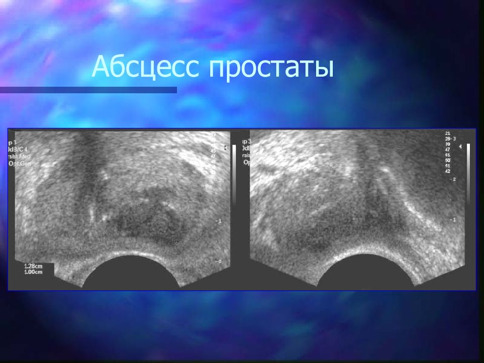 Уз признаки предстательной железы. Абсцесс предстательной железы. УЗИ предстательной железы. Кисты предстательной железы на УЗИ.