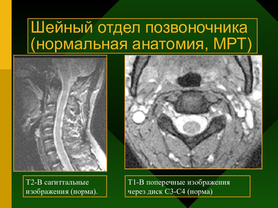 Лучевая диагностика позвоночник презентация