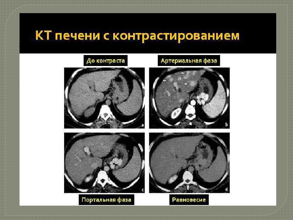 Кт норма печень. Портальная фаза контрастирования при кт. Динамическое контрастирование печени мрт. Мрт с контрастом фазы. Кт с контрастом печени фазы.