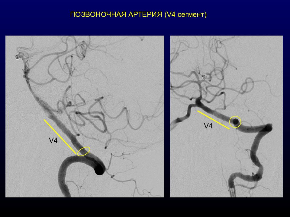 4 сегмент. 4 Сегмент позвоночной артерии. Сегмент v1 позвоночной артерии. Сегменты v1 v2 позвоночных артерий. V5 сегмент позвоночной артерии.