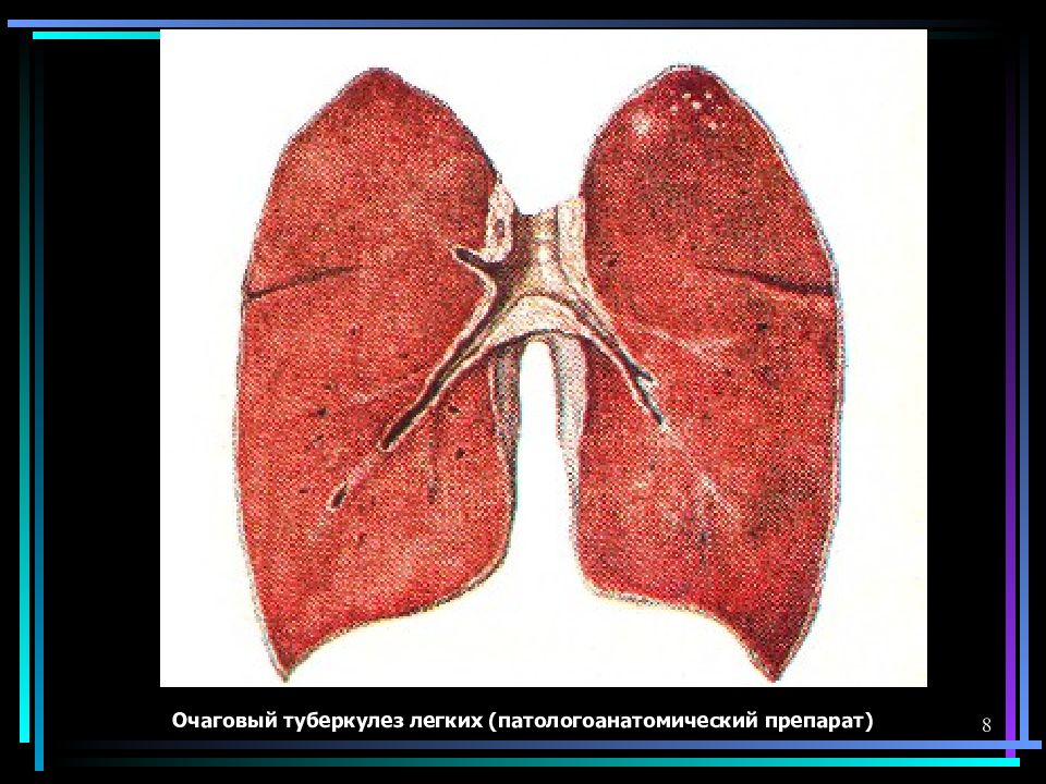 Очаговый туберкулез. Мягкоочаговый туберкулез. Острый очаговый туберкулез легкого макропрепарат. Очаговый туберкулез s2 левого легкого. Очаговый туберкулез патанатомия.